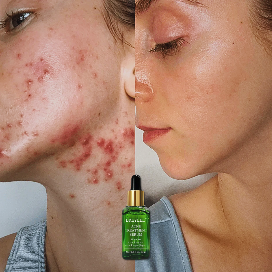 Tea Tree Acne Treatment Serum