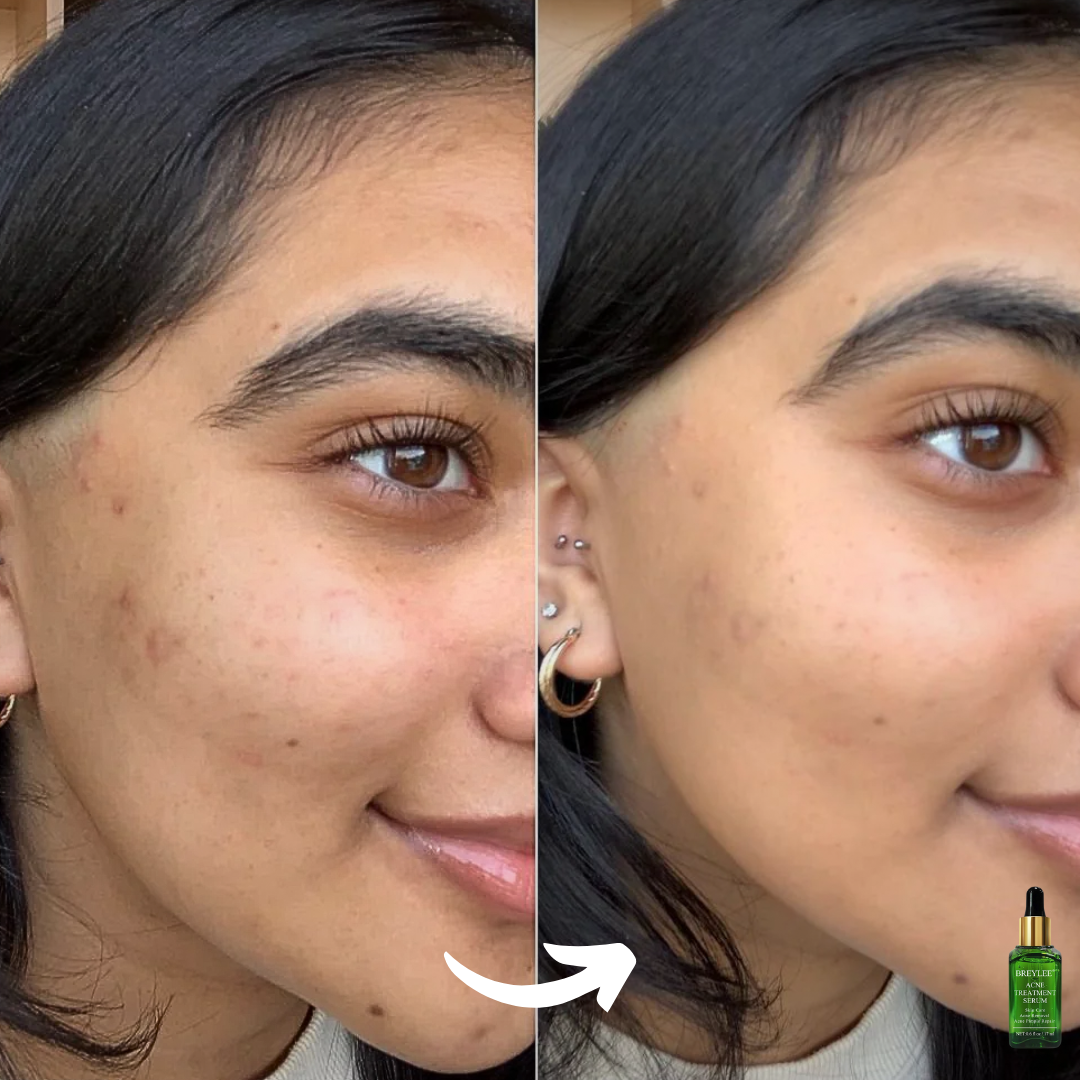 Tea Tree Acne Treatment Serum